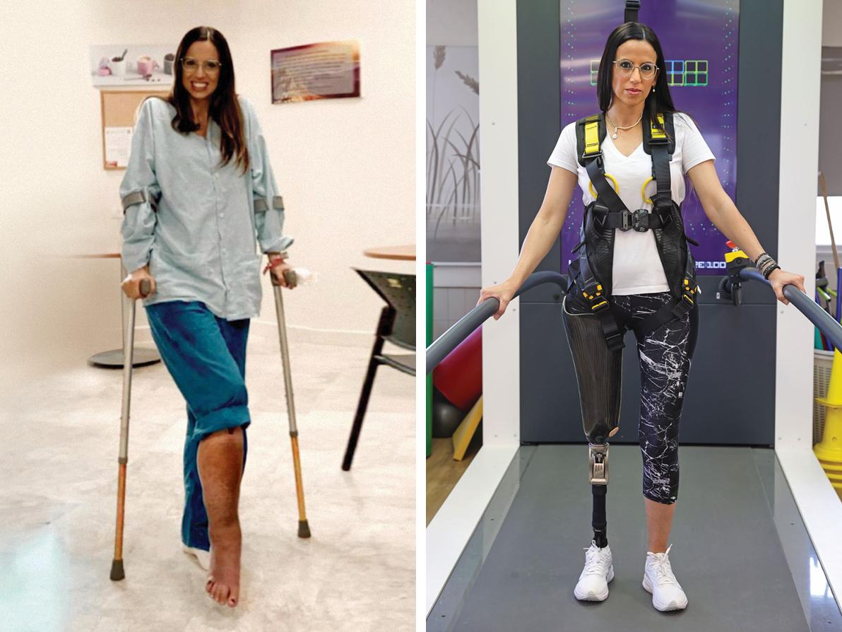 ליאורה קקון לפני ואחרי ניתוח כריתת הרגל