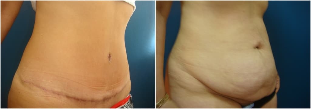ד"ר מוסקונה מתיחת בטן לפני ואחרי