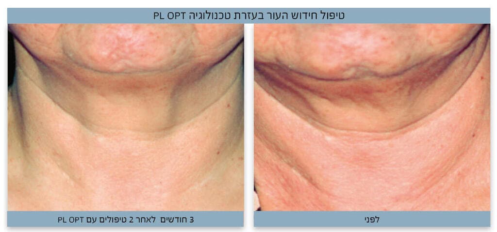 טיפול חידוש העור בעזרת טכנולוגיה PL OPT