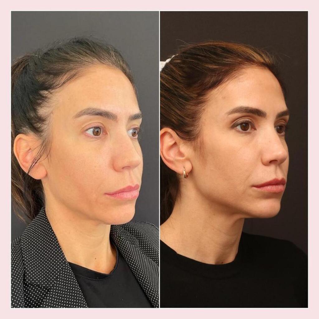 סקולפטרה לפני ואחרי, ניתוח מיני פייסט ליפט, ד"ר אברי רווה