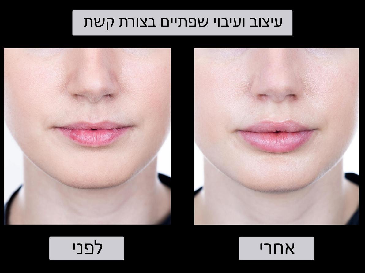 עיבוי שפתיים, לפני ואחרי