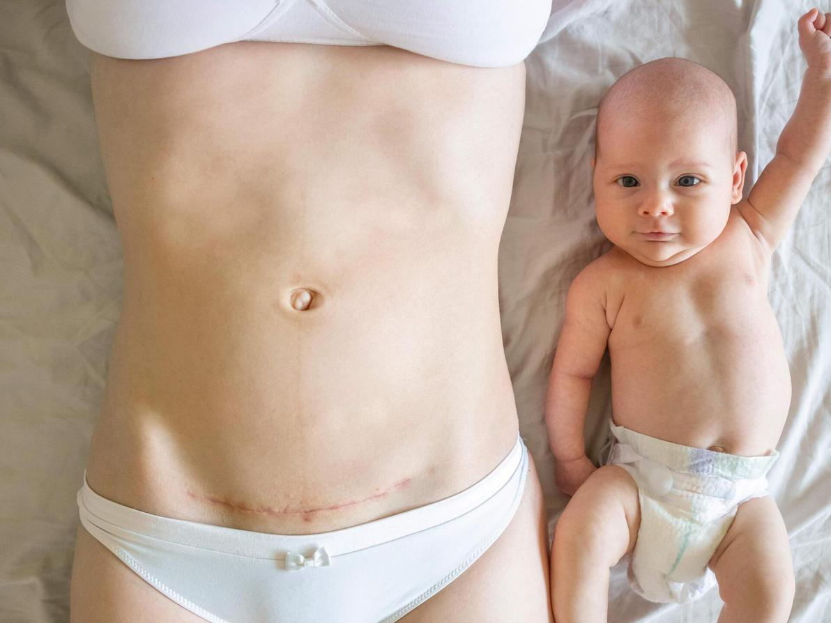 אמא לאחר ניתוח קיסרי