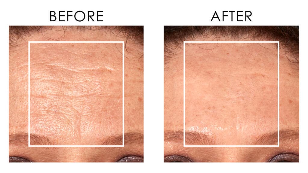 פריצת דרך בטייפול בקמטים