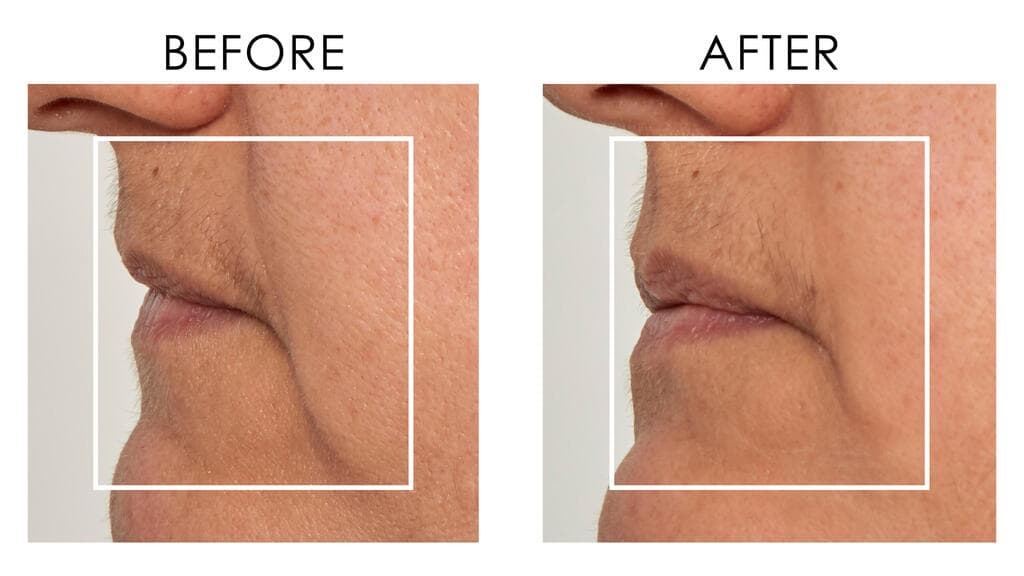 פריצת דרך בטייפול בקמטים