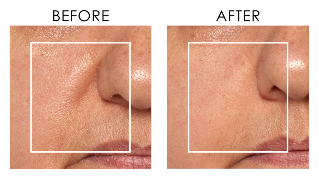 פריצת דרך בטייפול בקמטים