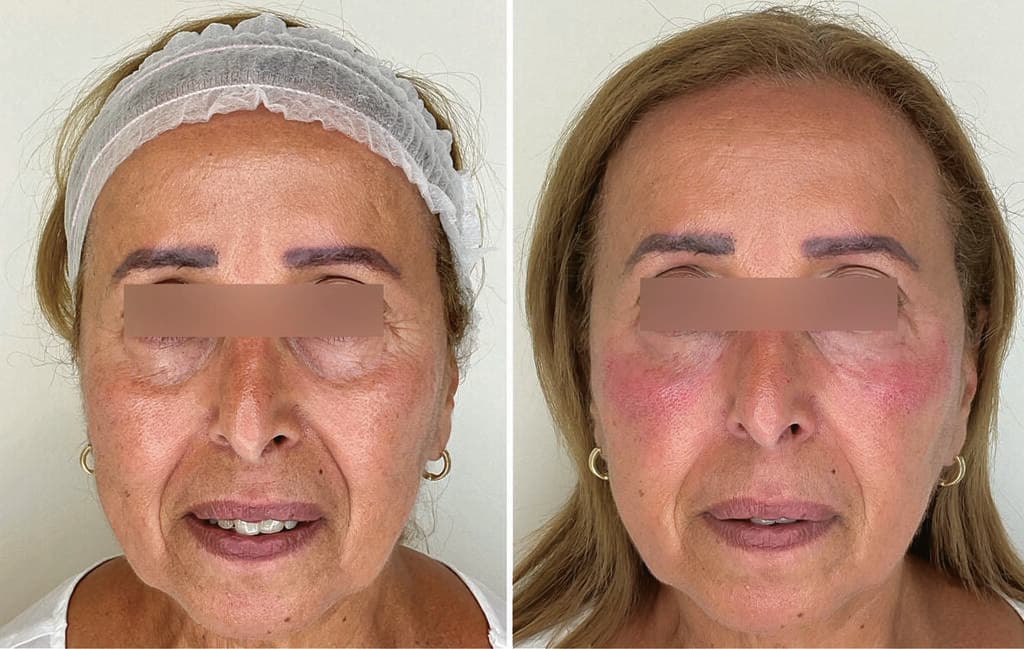 מימין: אחרי. משמאל: לפני (צילום: ד"ר לידור שמואלי) מימין: אחרי. משמאל: לפני