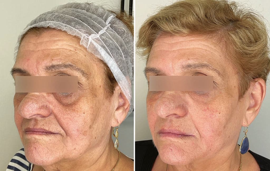 מימין: אחרי. משמאל: לפני (צילום: ד"ר לידור שמואלי) מימין: אחרי. משמאל: לפני