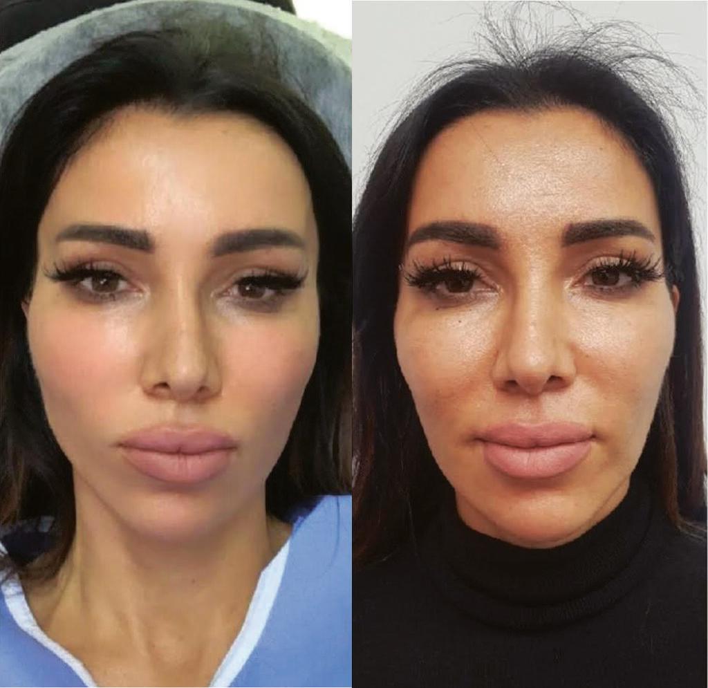 הרמה בחוטים לפני ואחרי