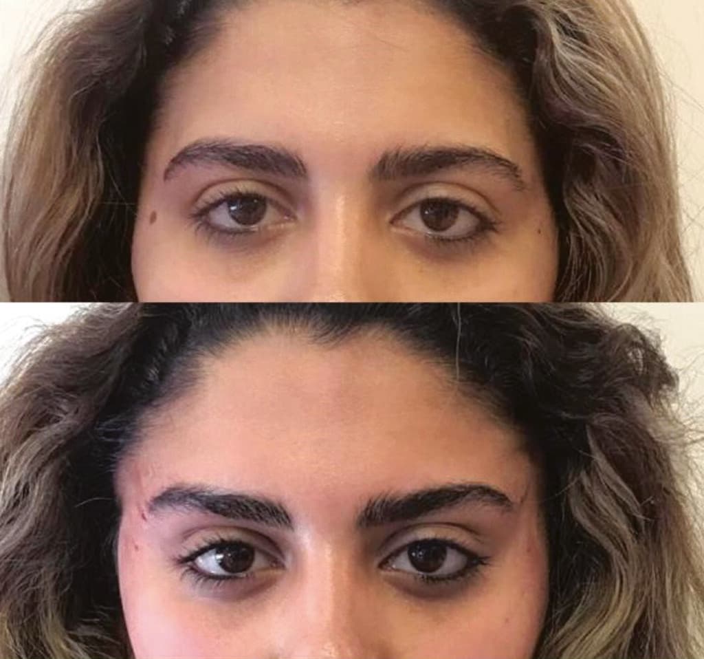 הרמה בחוטים לפני ואחרי