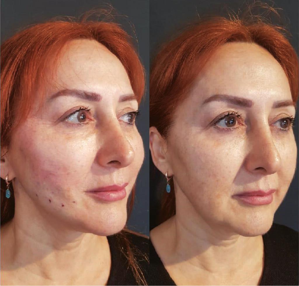 הרמה בחוטים לפני ואחרי