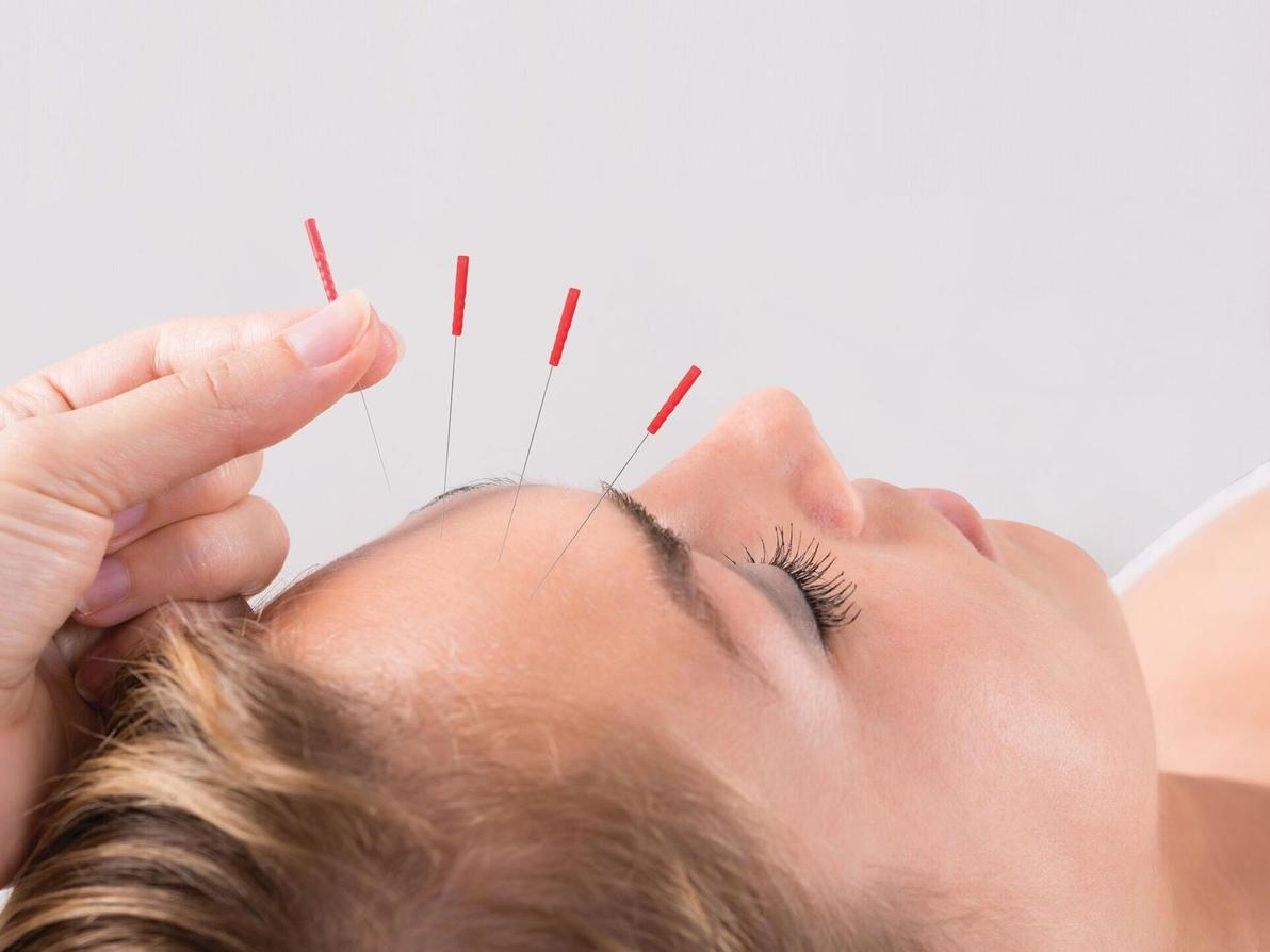 דיקור קוסמטי