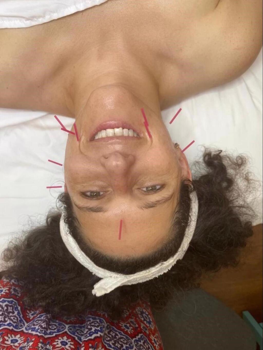 נועה קולר בדיקור אצל עופרי בס