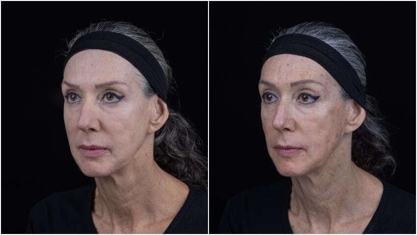 לפני (מימין) ואחרי