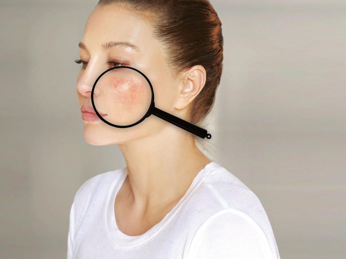 "הטיפול בלופוס עבר בשנים האחרונות התקדמות משמעותית."