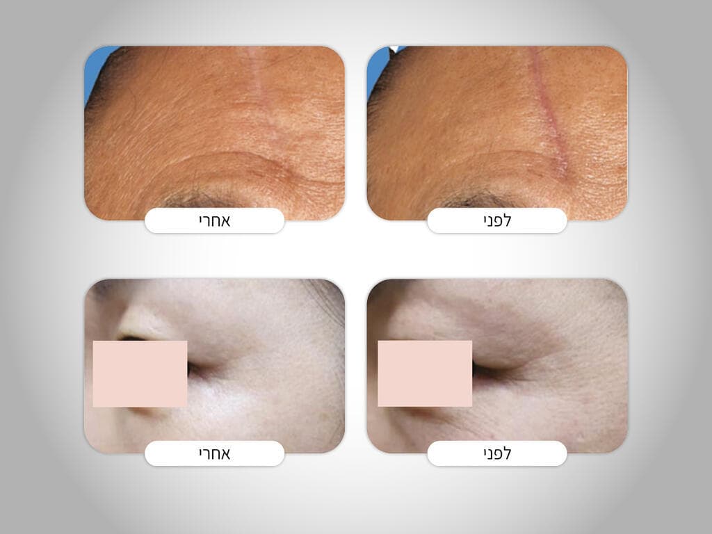 לפני ואחרי עם Rejuran