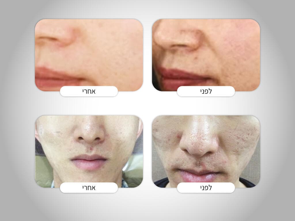 לפני ואחרי עם Rejuran