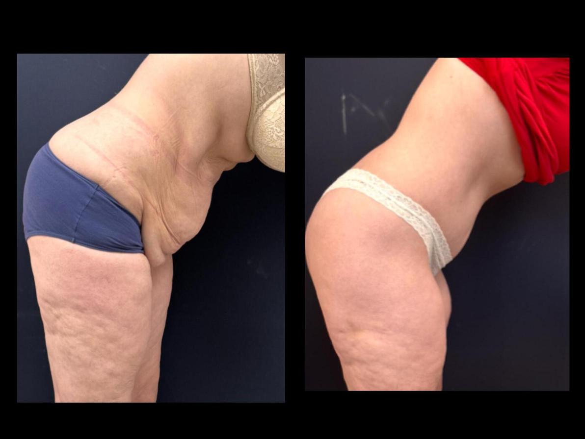  לפני ואחרי ניתוח לעיצוב הגוף