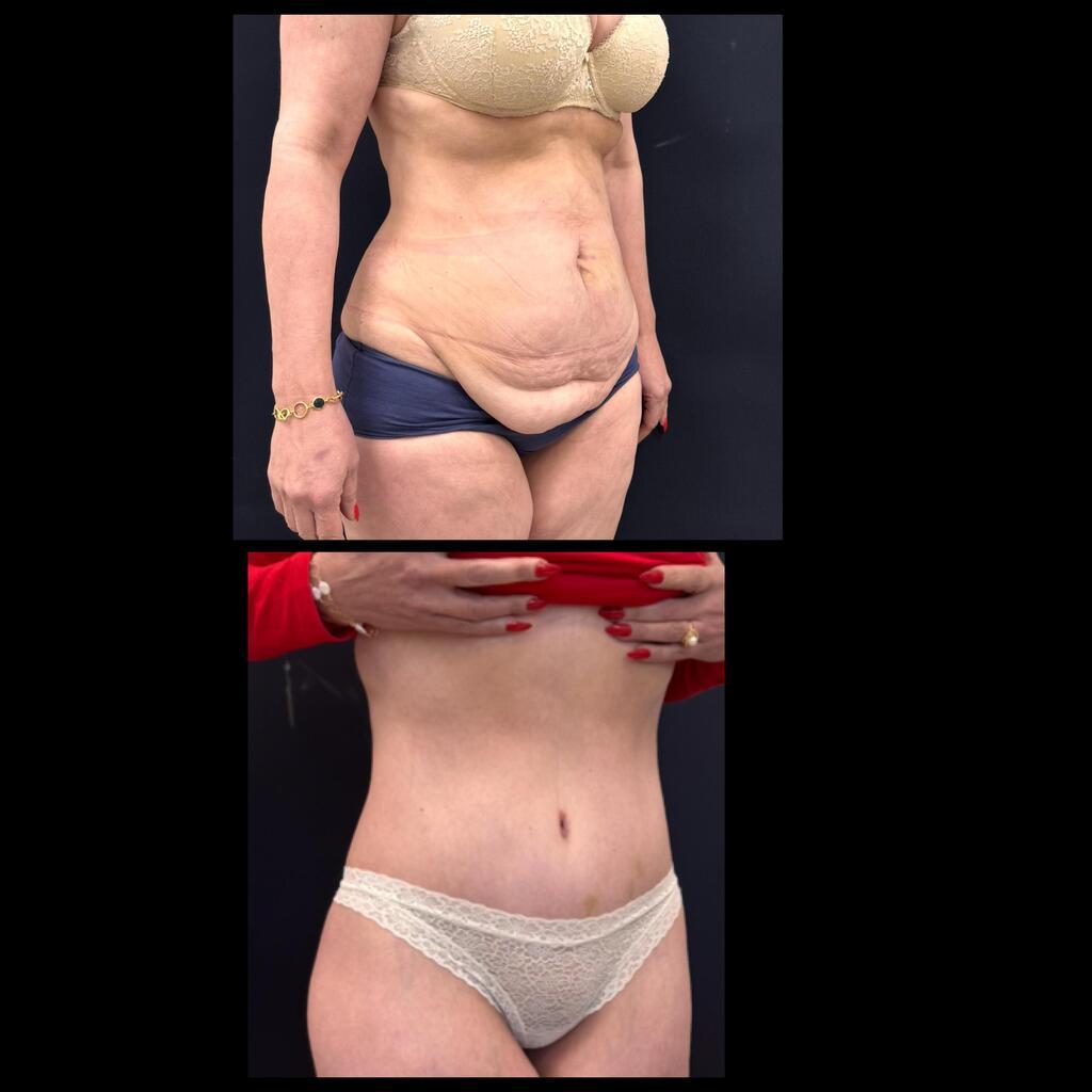  מתיחות בטן וניתוחי חזה בשיטה חדשנית ללא נקזים 