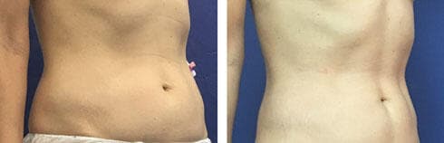 מיטל לפני הניתוח ואחריו (צילום: אלבום פרטי) מיטל לפני הניתוח ואחריו