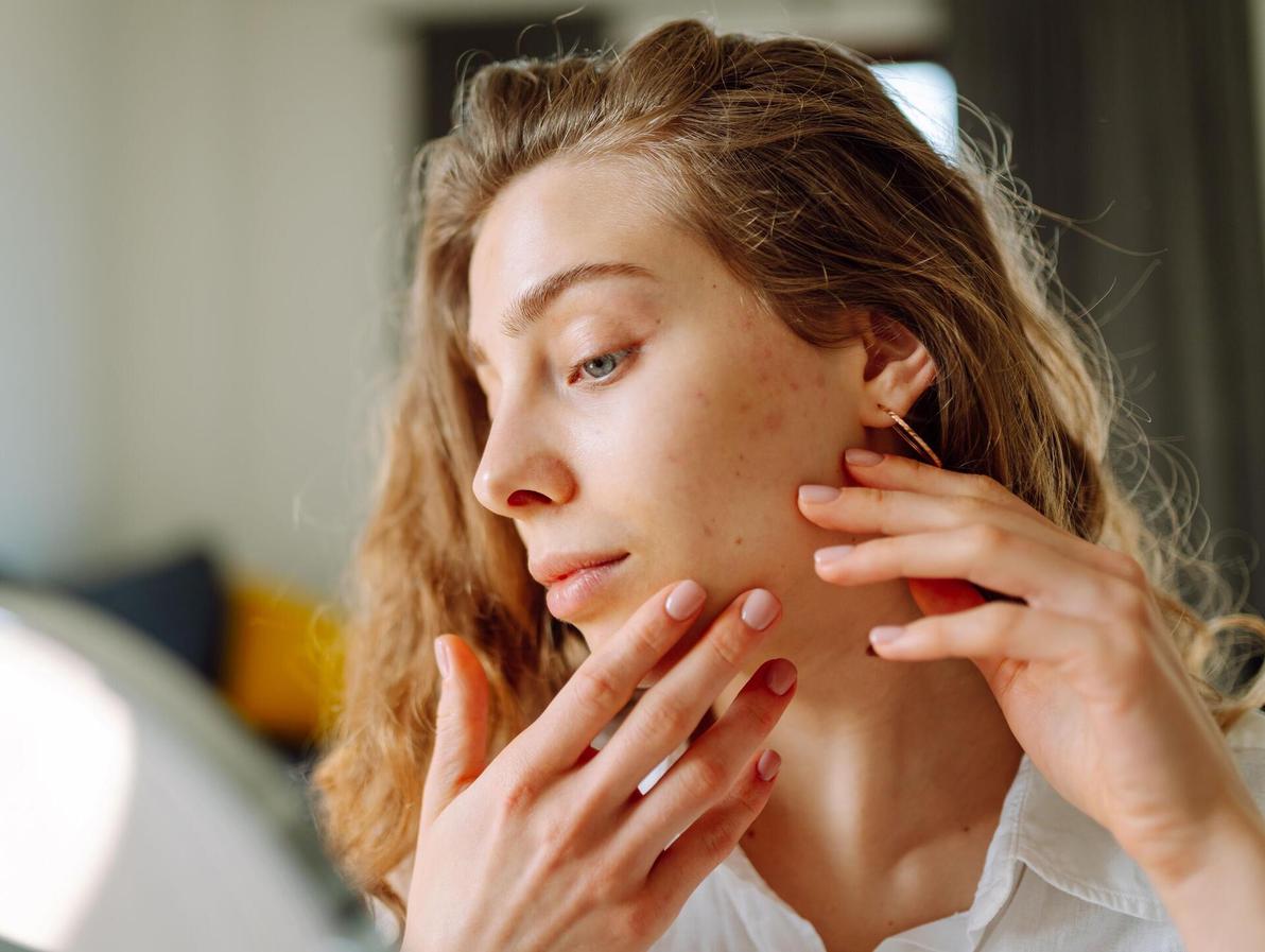בעיות עור אקנה פיגמטציה נקבוביות פעורות