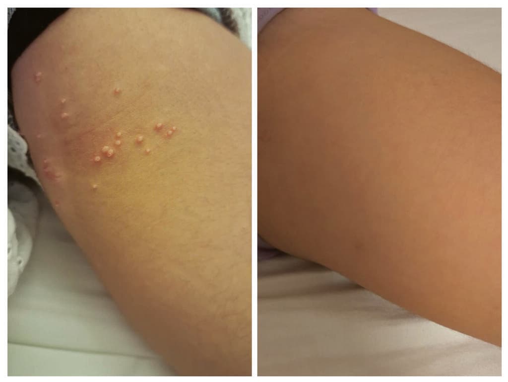 מולסקום בעור