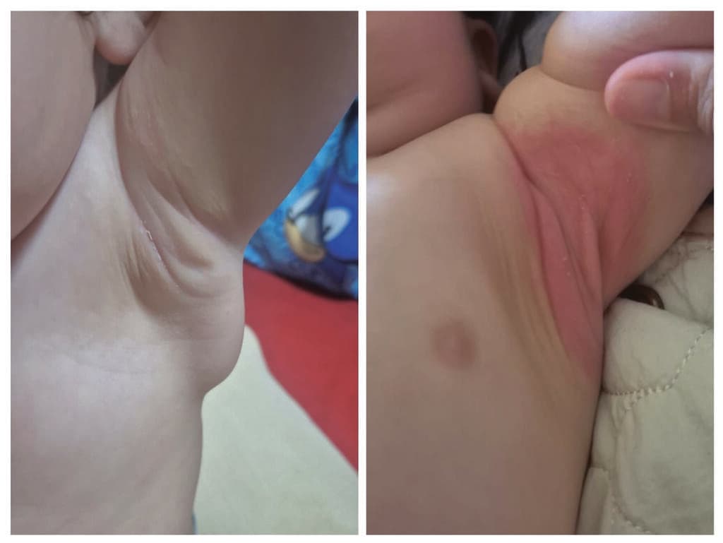 אטופיק דרמטיטיס