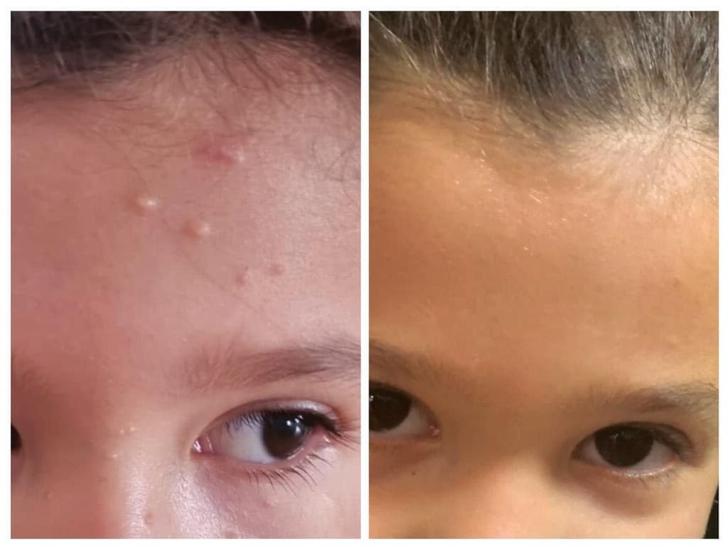 מולסקום בעור