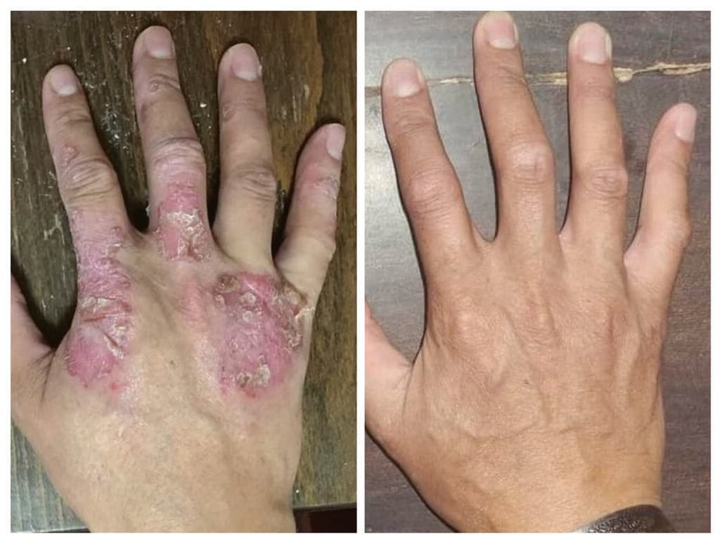 פסוריאזיס בעור