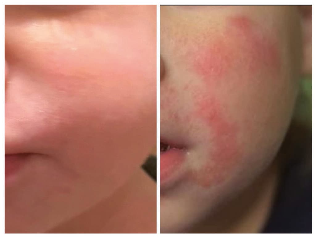 אטופיק דרמטיטיס