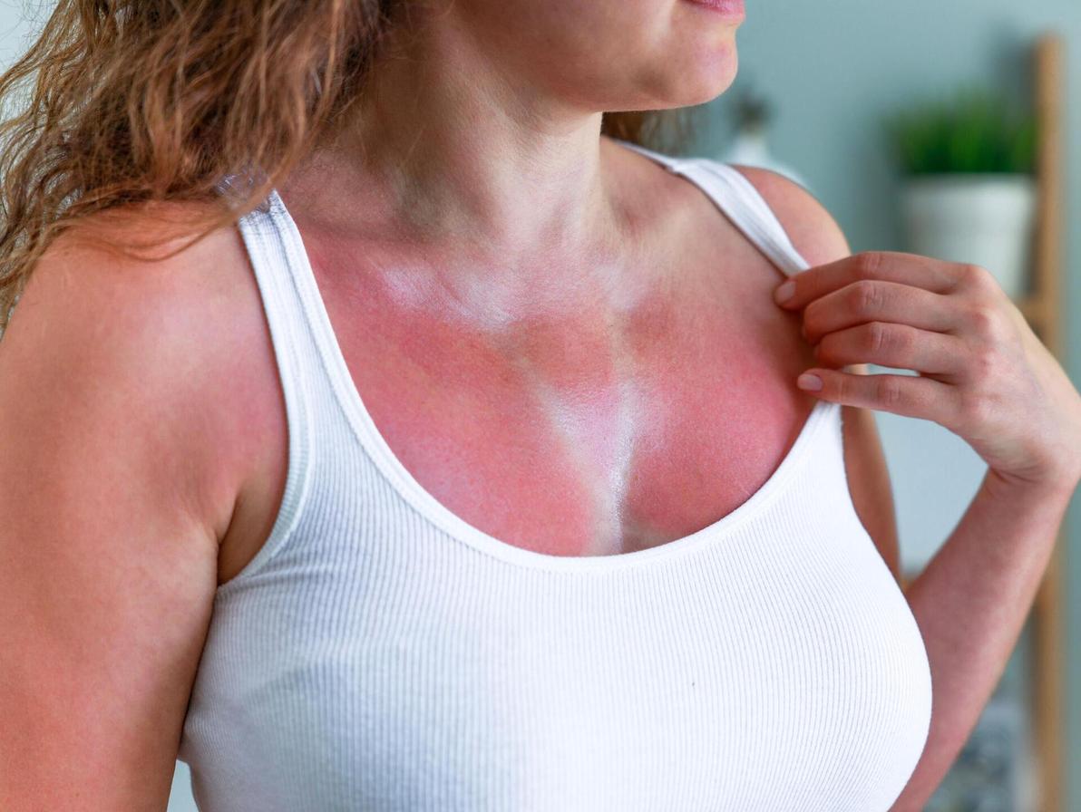 בהצלחה לנו עם זה (צילום: Shutterstock/ASAP creative) נערה שזופה נשרפה מהשמש