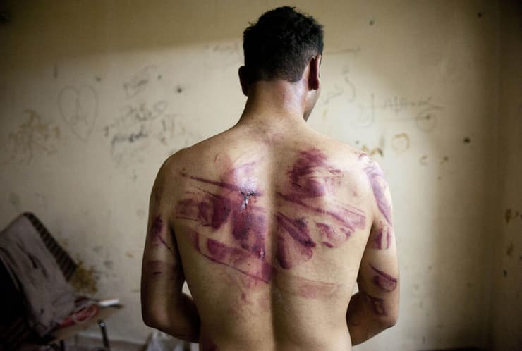 סורי מחלב שעבר עינויים מראה את גבו הפצוע, 2012