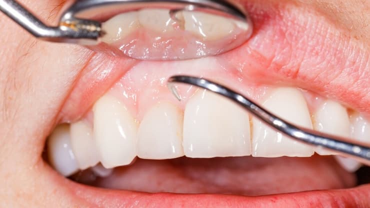 השלב הראשון בטיפול מקיף בשיניים ובחניכיים (טיפול פריודונטלי) הוא שינוי בהרגלים של גהות הפה והגברת מוטיבציה לשליטה בגורמי הסיכון