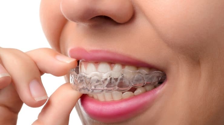 יישור שיניים בשיטה הדיגיטלית