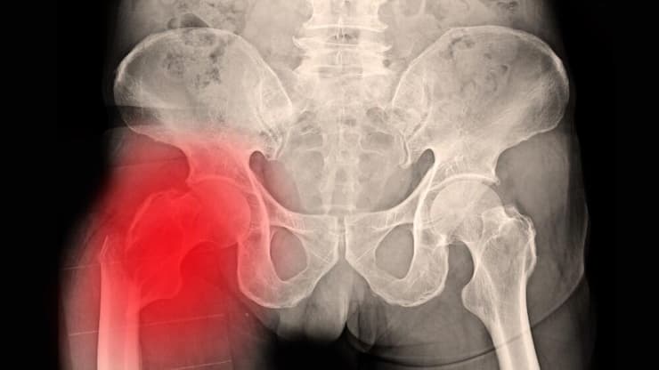 צילום רנטגן של שבר בצוואר הירך. שכיחות מוגברת בקרב אלו שנטלו את חוסמי משאבות המימן מעל חמש שנים