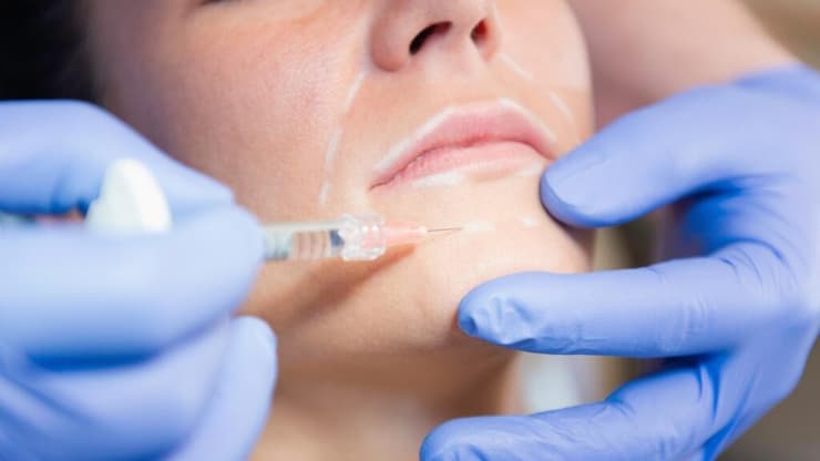 משרד הבריאות מזהיר משימוש בעטי חומצה היאלורונית שלא אושרו. אילוסטרציה