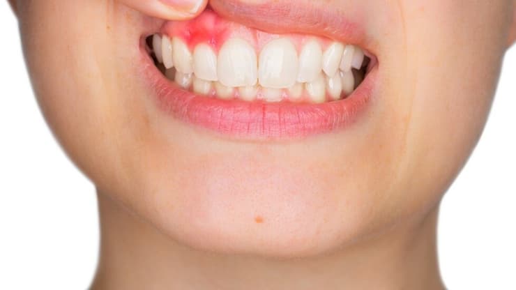 אחת הסיבות האפשריות לרגישות בשיניים - מחלת חניכיים