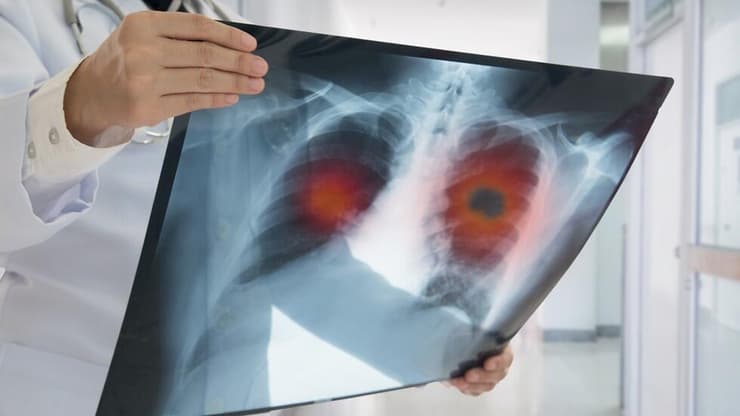 תגליתו של רנטגן הובילה להתפתחות הרדיותרפיה – טיפול בסרטן באמצעות קרני X