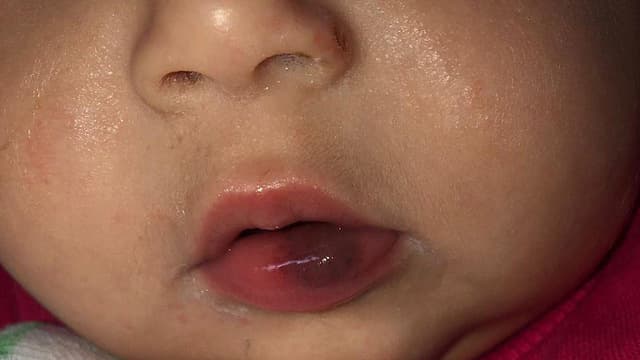 סימני האלימות על שפתיה של התינוקת