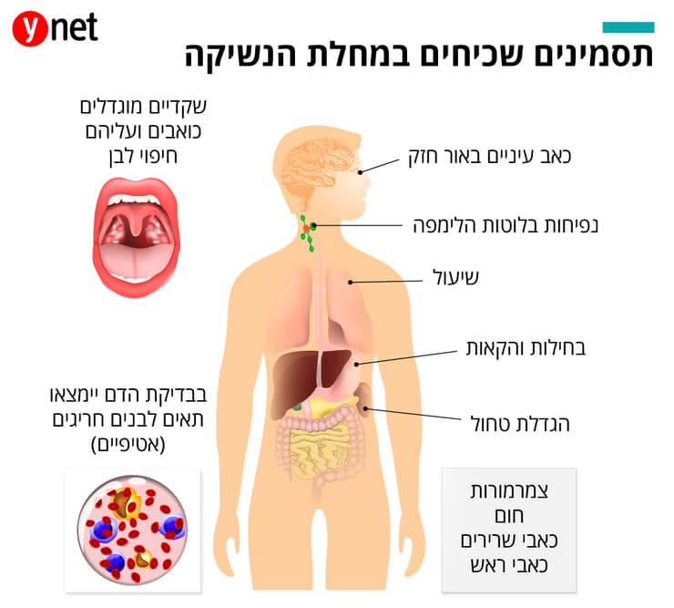 לכתבה תסמינים של מחלת הנשיקה