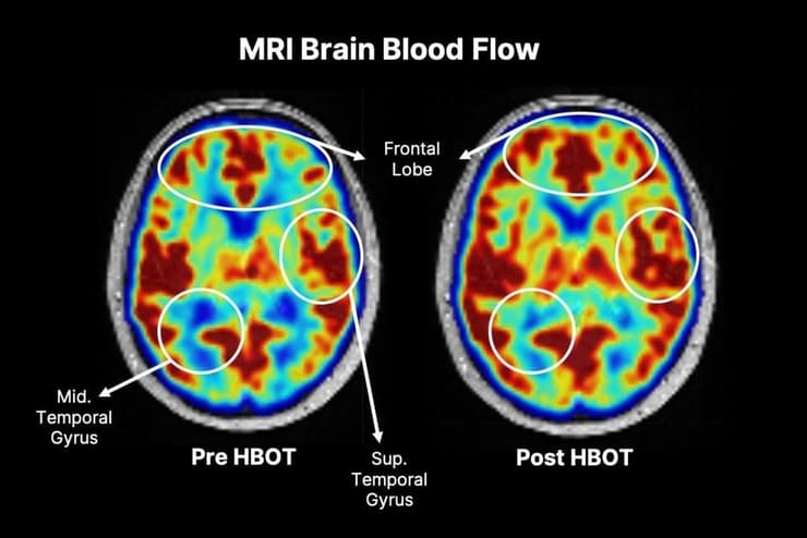 פעילות מוחית לפני ואחרי טיפול בתא לחץ