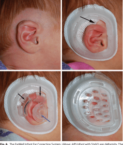 תיקון אוזניים לתינוקות ללא ניתוח