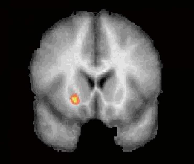 דימות fMRI המציג את הנקודה במוח שבה למידה מטעויות "מפריעה" להערכת הזמן: המבנה המוחי המכונה Putamen