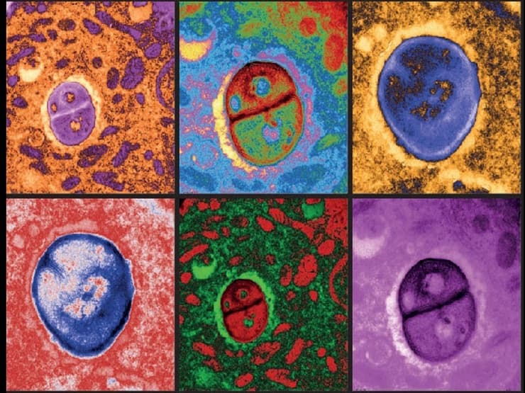 חיידקים המתארחים בתאי מלנומה תחת מיקרוסקופ אלקטרונים (התמונות עברו צביעה דיגיטלית)