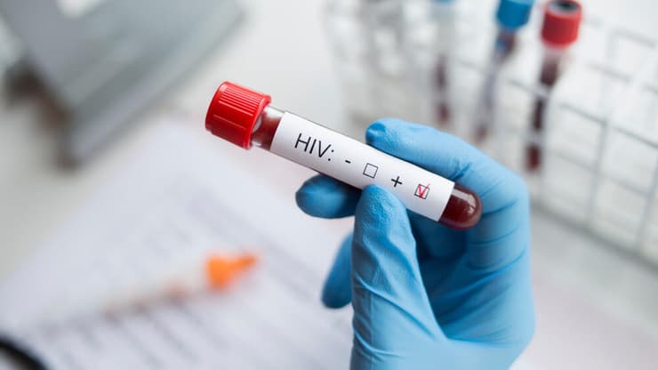 איידס HIV בדיקת דם