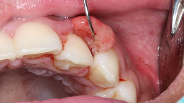 Oral Pyogenic Granuloma פיוגניק גרנולומה גידול שיניים חניכיים