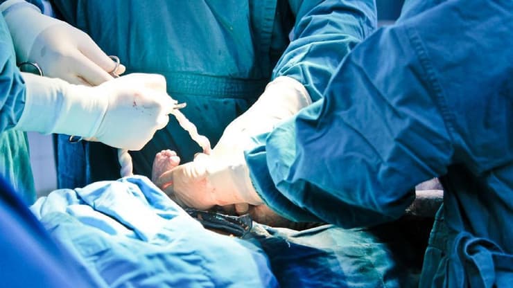 לידה ניתוח קיסרי