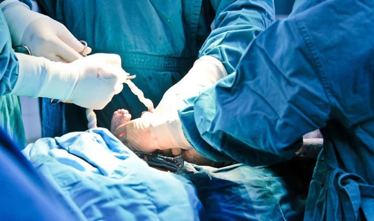 לידה ניתוח קיסרי