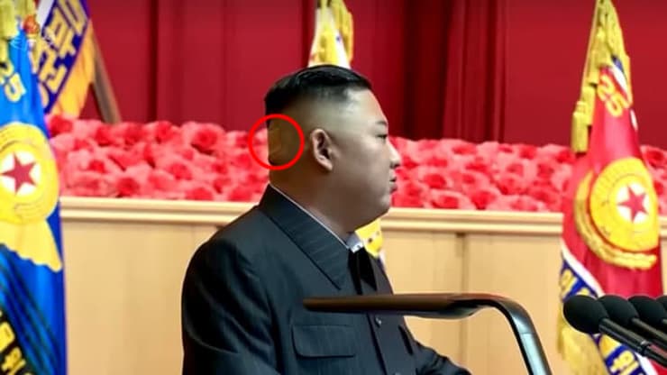 צפון קוריאה קים ג'ונג און פלסטר על הראש