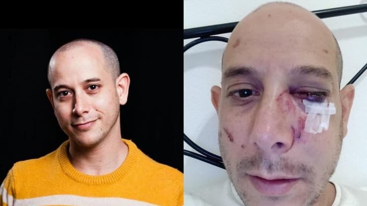 אלעד פורגש, ישראלי שהותקף בפיזה איטליה