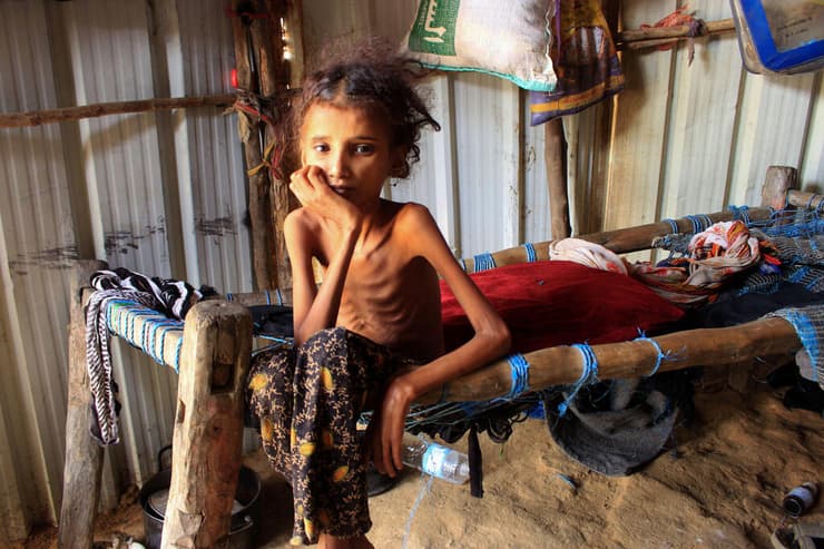 תמונות השנה של AFP שנת 2021 הילדה אחמדיה עבדו תת זונה שוקלת 10 קילו מחנה פליטים תימן 23 ינואר